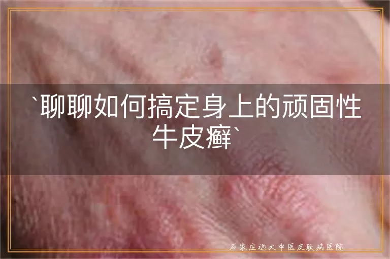 聊聊如何搞定身上的顽固性牛皮癣