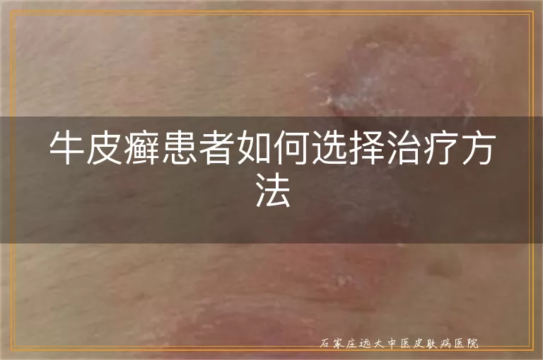 牛皮癣患者如何选择治疗方法