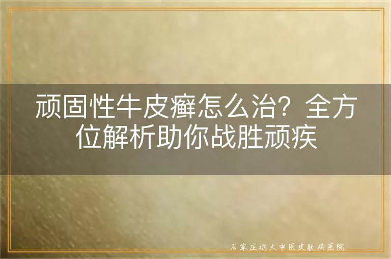 顽固性牛皮癣怎么治？全方位解析助你战胜顽疾