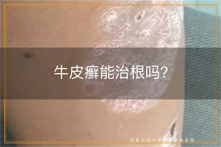 牛皮癣能治根吗？