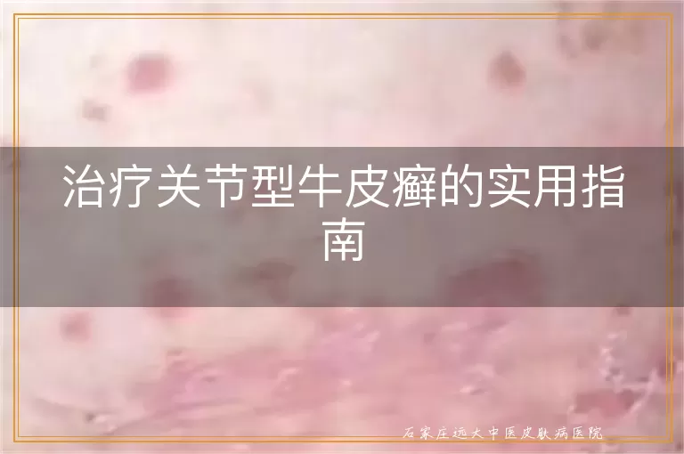 治疗关节型牛皮癣的实用指南