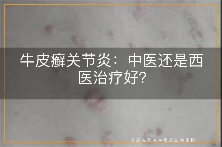 牛皮癣关节炎：中医还是西医治疗好？