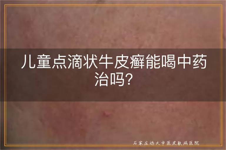 儿童点滴状牛皮癣能喝中药治吗？