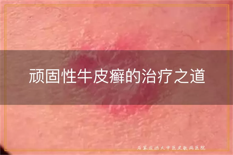 顽固性牛皮癣的治疗之道