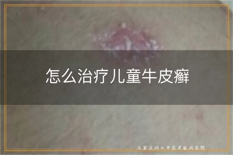 怎么治疗儿童牛皮癣