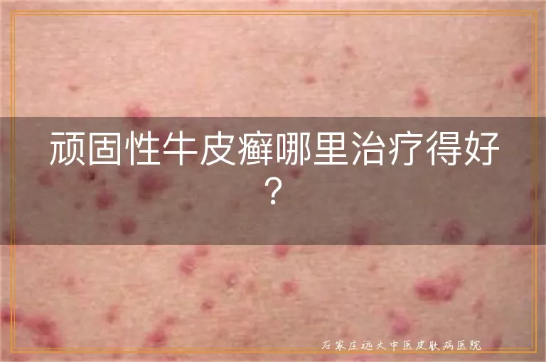 顽固性牛皮癣哪里治疗得好？