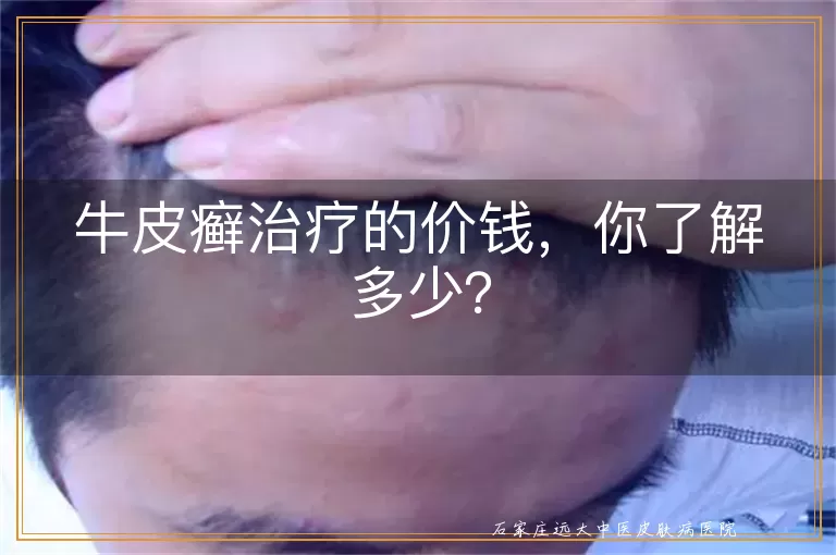 牛皮癣治疗的价钱，你了解多少？