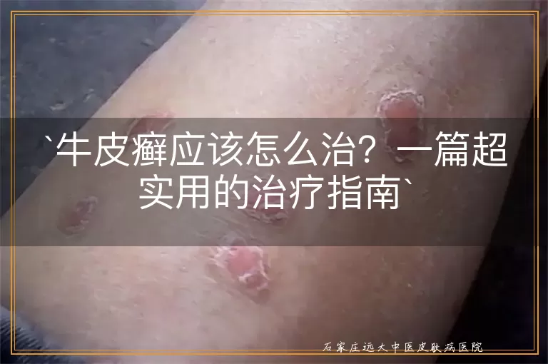 牛皮癣应该怎么治？一篇超实用的治疗指南