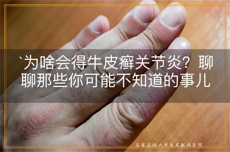 为啥会得牛皮癣关节炎？聊聊那些你可能不知道的事儿