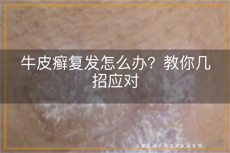 牛皮癣复发怎么办？教你几招应对