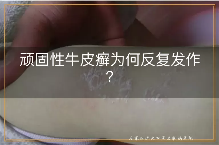 顽固性牛皮癣为何反复发作？