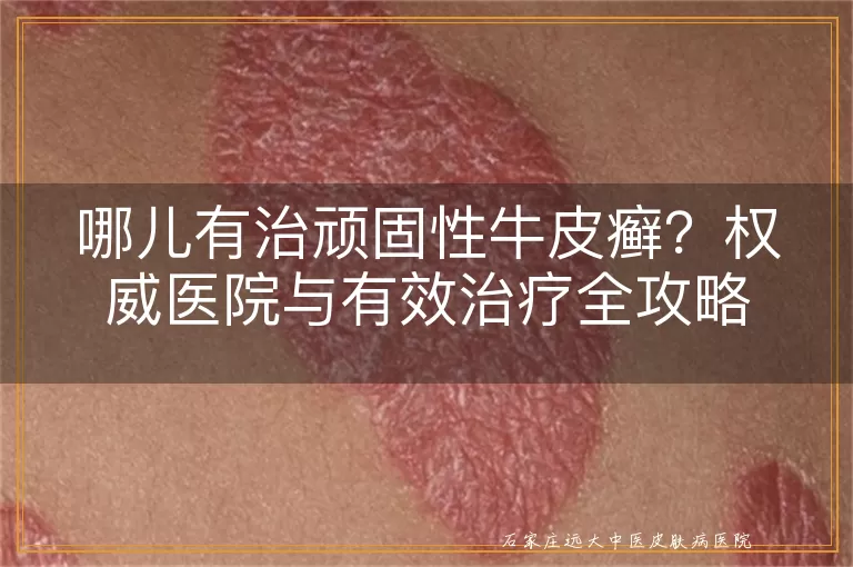 哪儿有治顽固性牛皮癣？权威医院与有效治疗全攻略