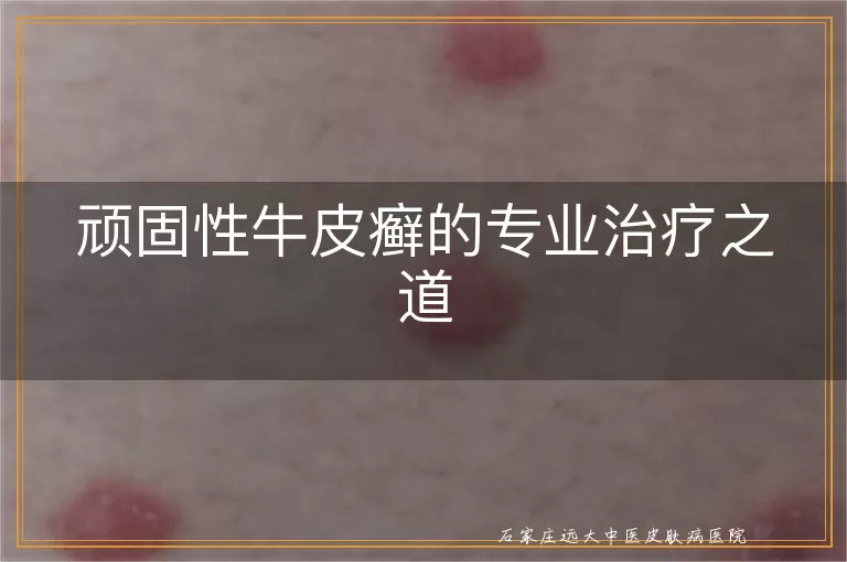 顽固性牛皮癣的专业治疗之道