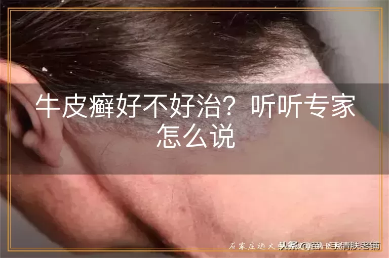 牛皮癣好不好治？听听专家怎么说