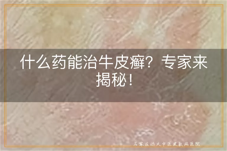 什么药能治牛皮癣？专家来揭秘！