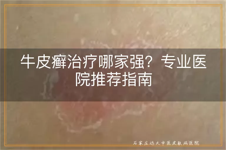 牛皮癣治疗哪家强？专业医院推荐指南