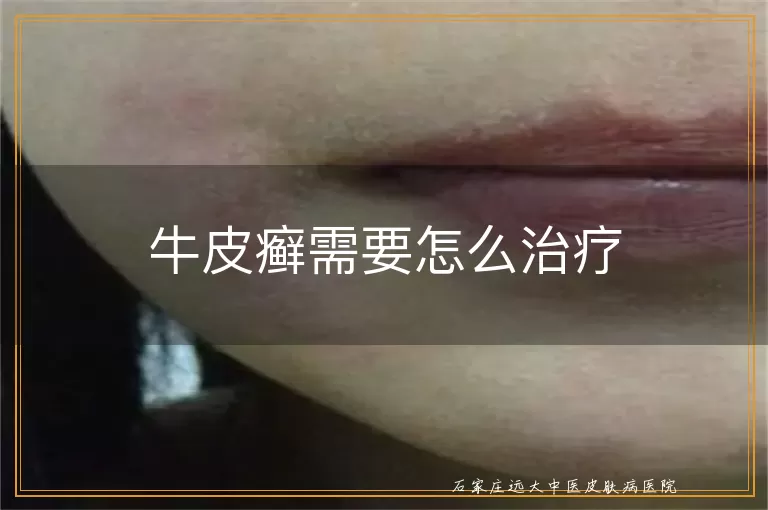 牛皮癣需要怎么治疗