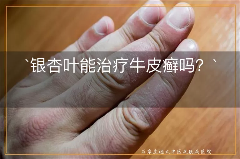 银杏叶能治疗牛皮癣吗？