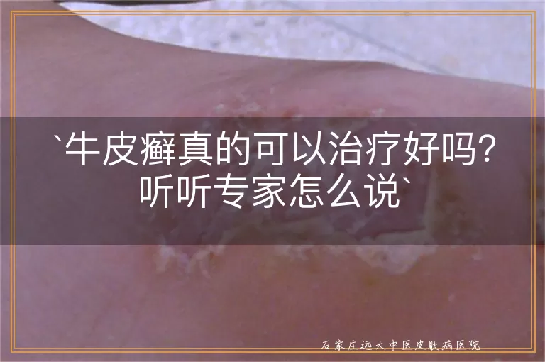 牛皮癣真的可以治疗好吗？听听专家怎么说