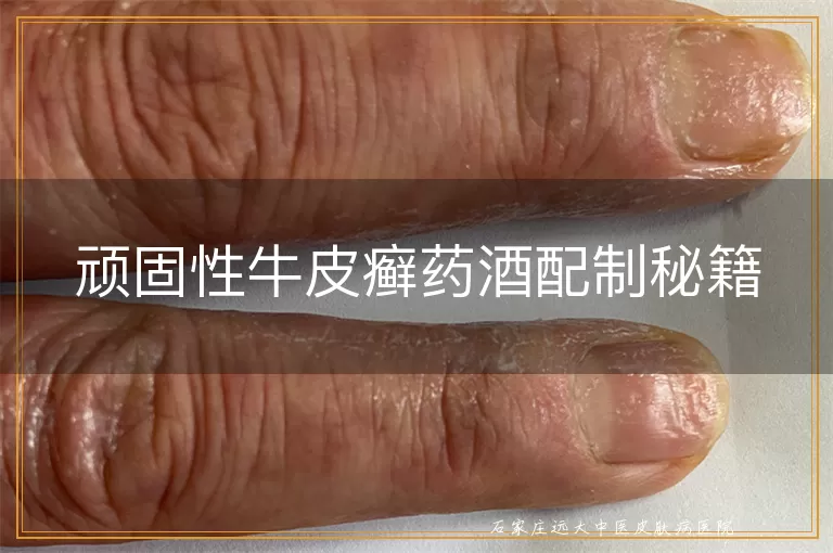 顽固性牛皮癣药酒配制秘籍