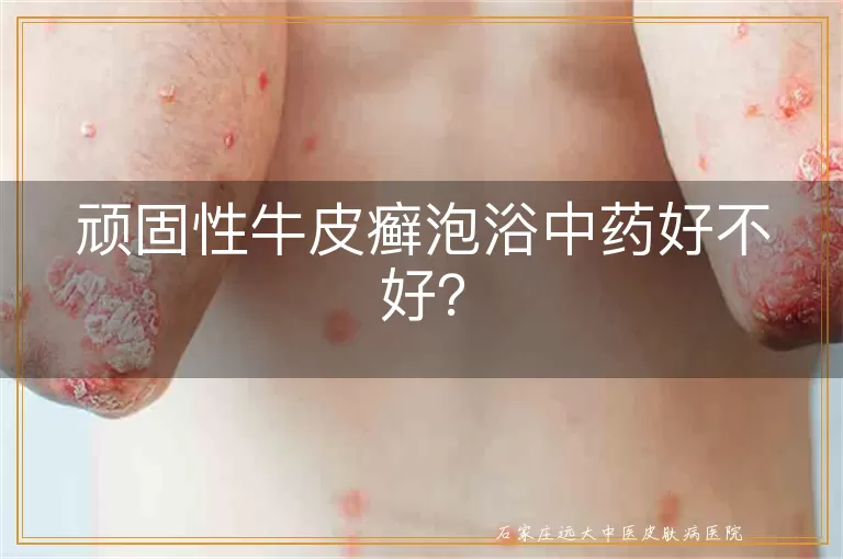 顽固性牛皮癣泡浴中药好不好？