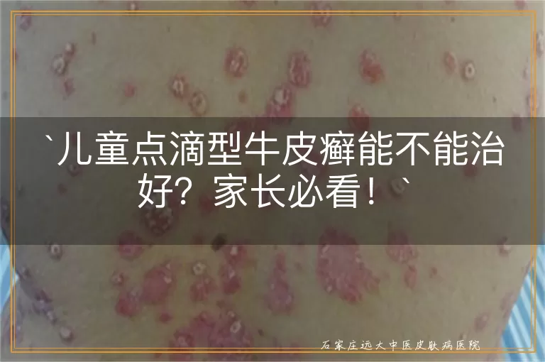 儿童点滴型牛皮癣能不能治好？家长必看！