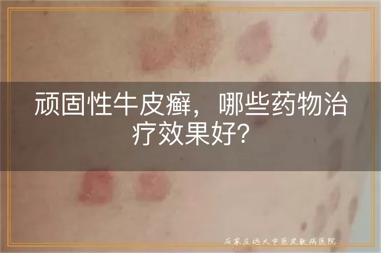 顽固性牛皮癣，哪些药物治疗效果好？