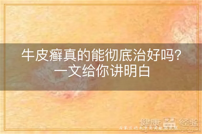 牛皮癣真的能彻底治好吗？一文给你讲明白