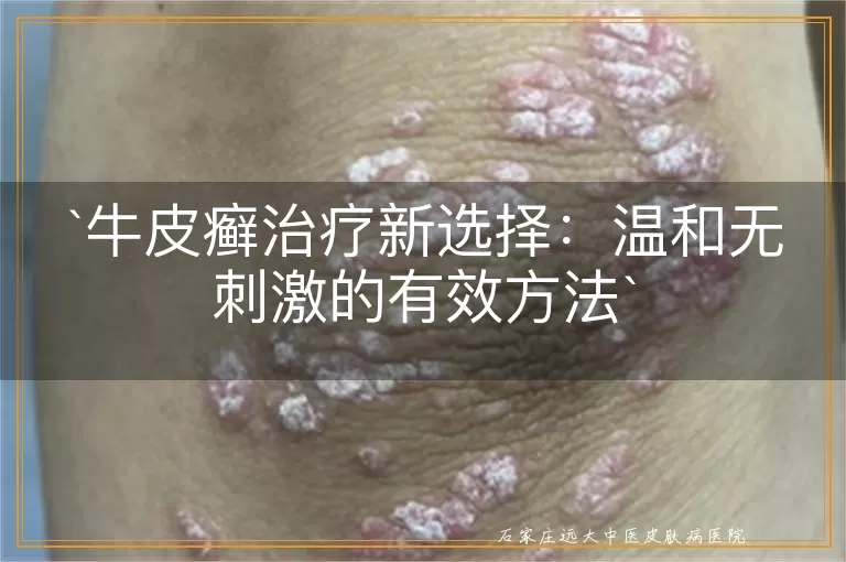 牛皮癣治疗新选择：温和无刺激的有效方法