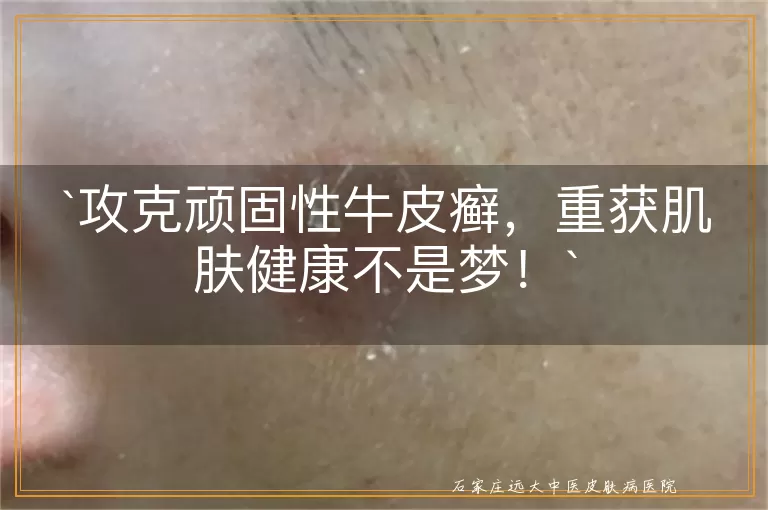 攻克顽固性牛皮癣，重获肌肤健康不是梦！