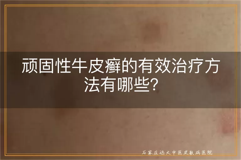 顽固性牛皮癣的有效治疗方法有哪些？