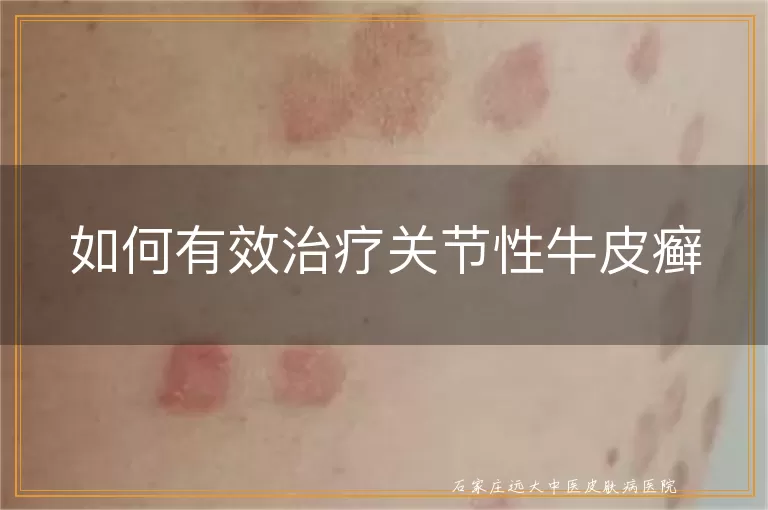 如何有效治疗关节性牛皮癣