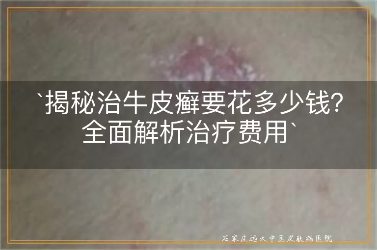 揭秘治牛皮癣要花多少钱？全面解析治疗费用