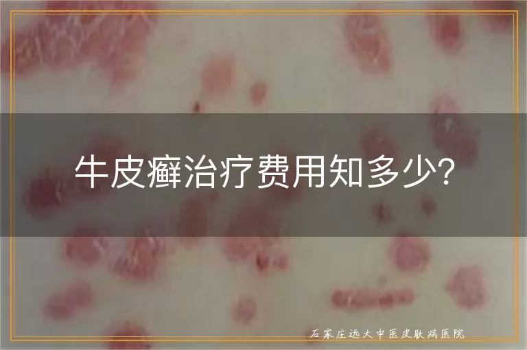 牛皮癣治疗费用知多少？