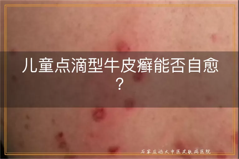 儿童点滴型牛皮癣能否自愈？