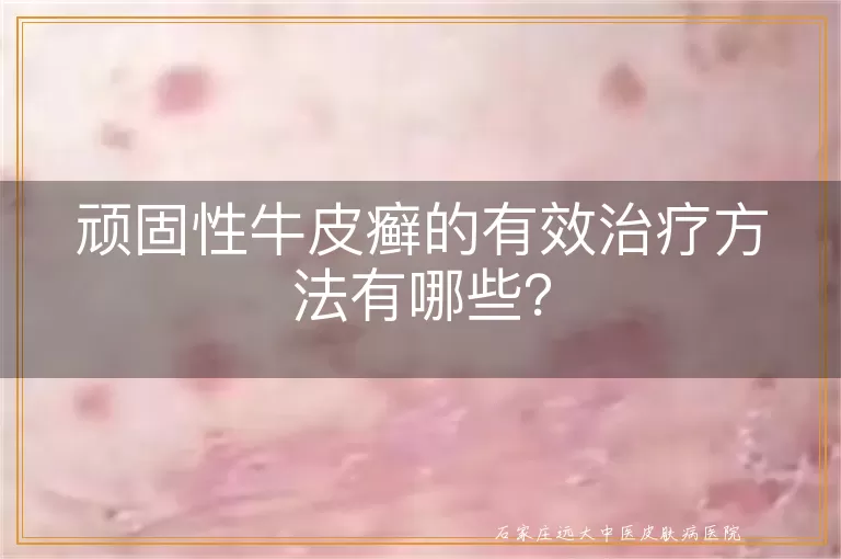 顽固性牛皮癣的有效治疗方法有哪些？