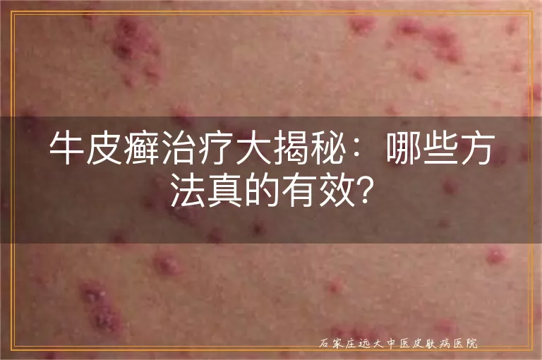 牛皮癣治疗大揭秘：哪些方法真的有效？