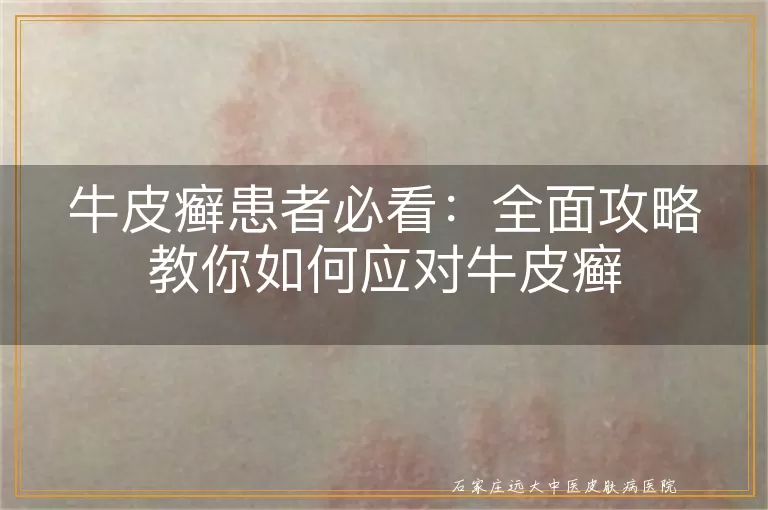 牛皮癣患者必看：全面攻略教你如何应对牛皮癣