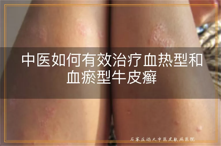 中医如何有效治疗血热型和血瘀型牛皮癣