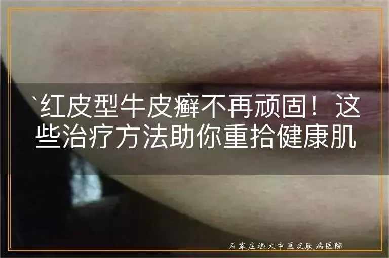 红皮型牛皮癣不再顽固！这些治疗方法助你重拾健康肌肤