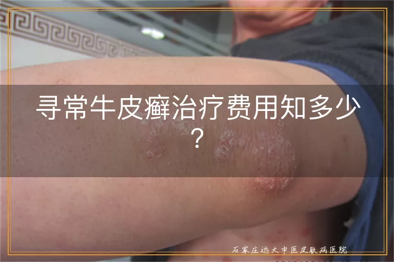 寻常牛皮癣治疗费用知多少？