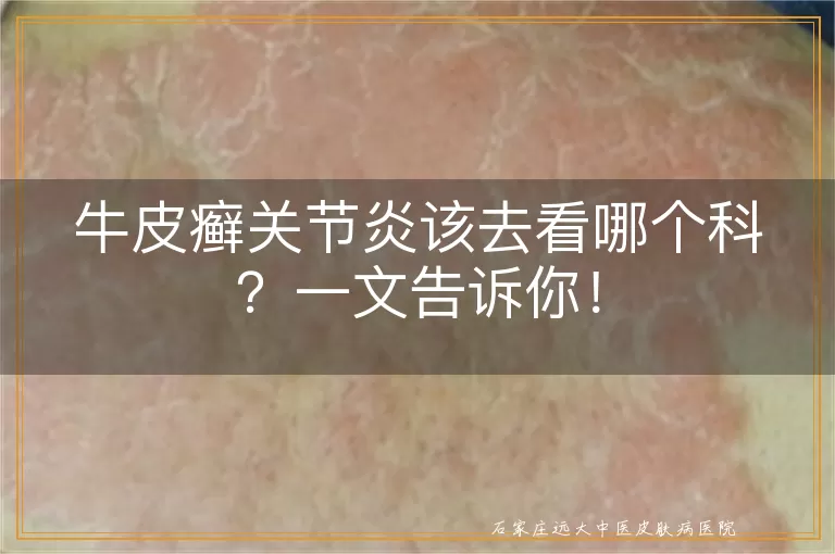 牛皮癣关节炎该去看哪个科？一文告诉你！