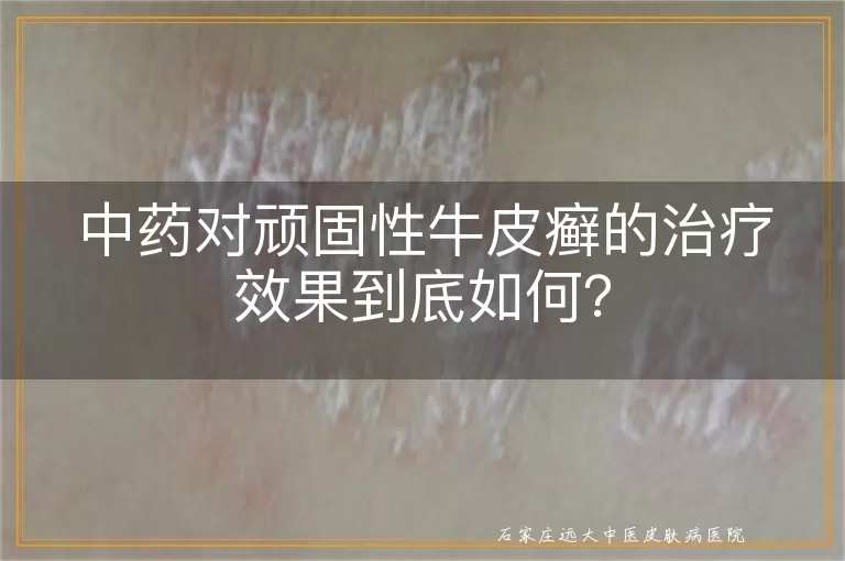 中药对顽固性牛皮癣的治疗效果到底如何？