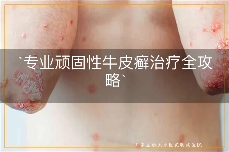 专业顽固性牛皮癣治疗全攻略