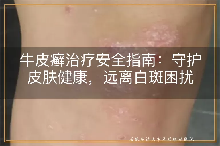 牛皮癣治疗安全指南：守护皮肤健康，远离白斑困扰