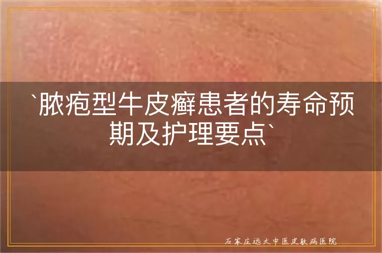 脓疱型牛皮癣患者的寿命预期及护理要点