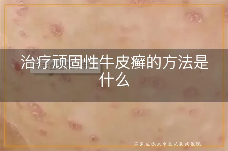 治疗顽固性牛皮癣的方法是什么