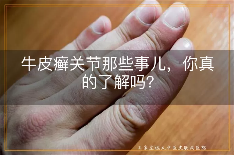 牛皮癣关节那些事儿，你真的了解吗？