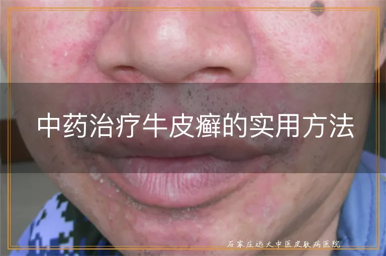 中药治疗牛皮癣的实用方法