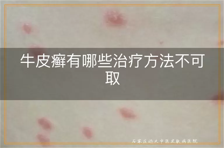 牛皮癣有哪些治疗方法不可取